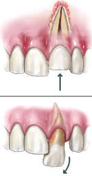 disloged tooth