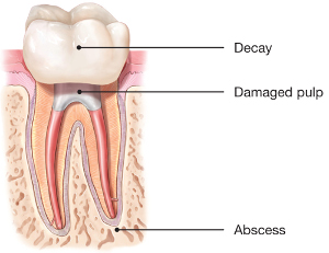 infected root canal